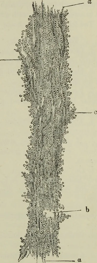 An illustration from A treatise on diseases of the skin with special reference to their diagnosis and treatment : including an analysis of 12,000 consecutive cases / Thomas McCall Anderson., 1894, leaf 613