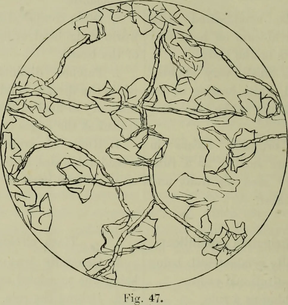 An illustration from A treatise on diseases of the skin with special reference to their diagnosis and treatment : including an analysis of 12,000 consecutive cases / Thomas McCall Anderson., 1894, leaf 618