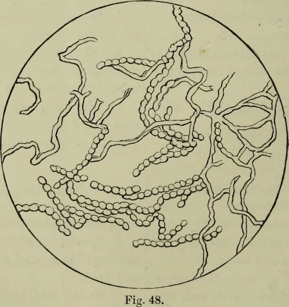 An illustration from A treatise on diseases of the skin with special reference to their diagnosis and treatment : including an analysis of 12,000 consecutive cases / Thomas McCall Anderson., 1894, leaf 618