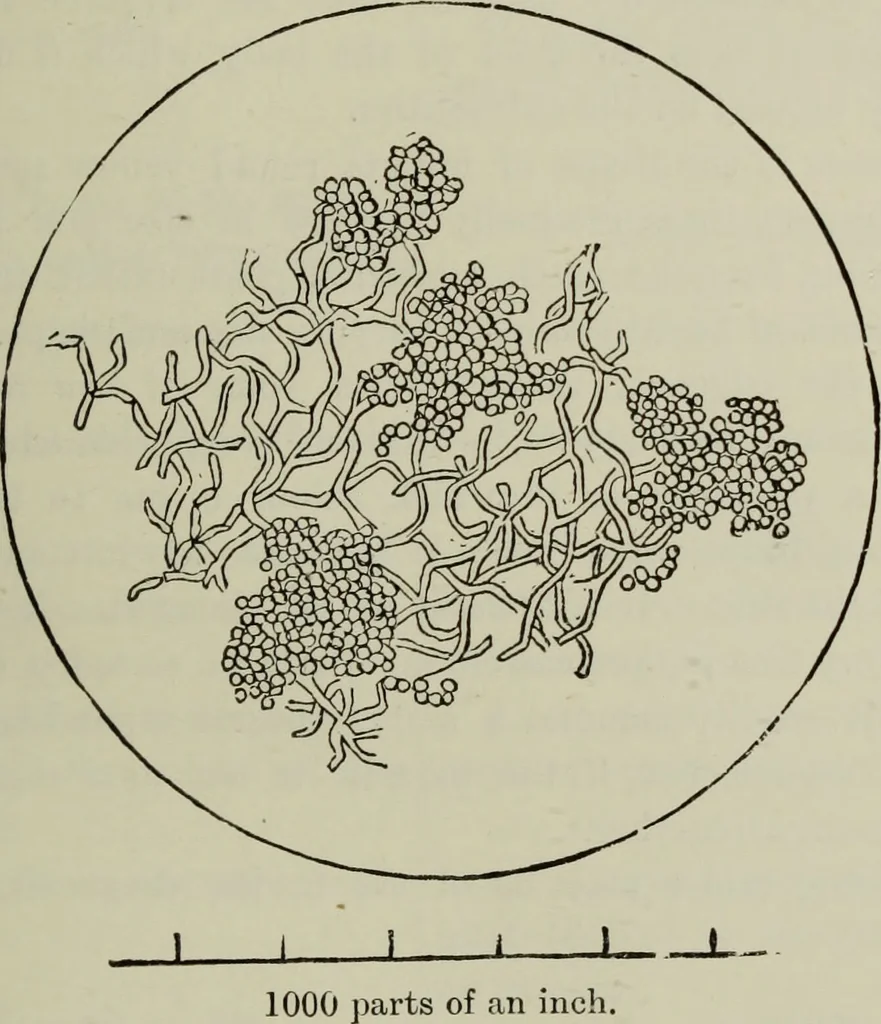 An illustration from A treatise on diseases of the skin with special reference to their diagnosis and treatment : including an analysis of 12,000 consecutive cases / Thomas McCall Anderson., 1894, leaf 629