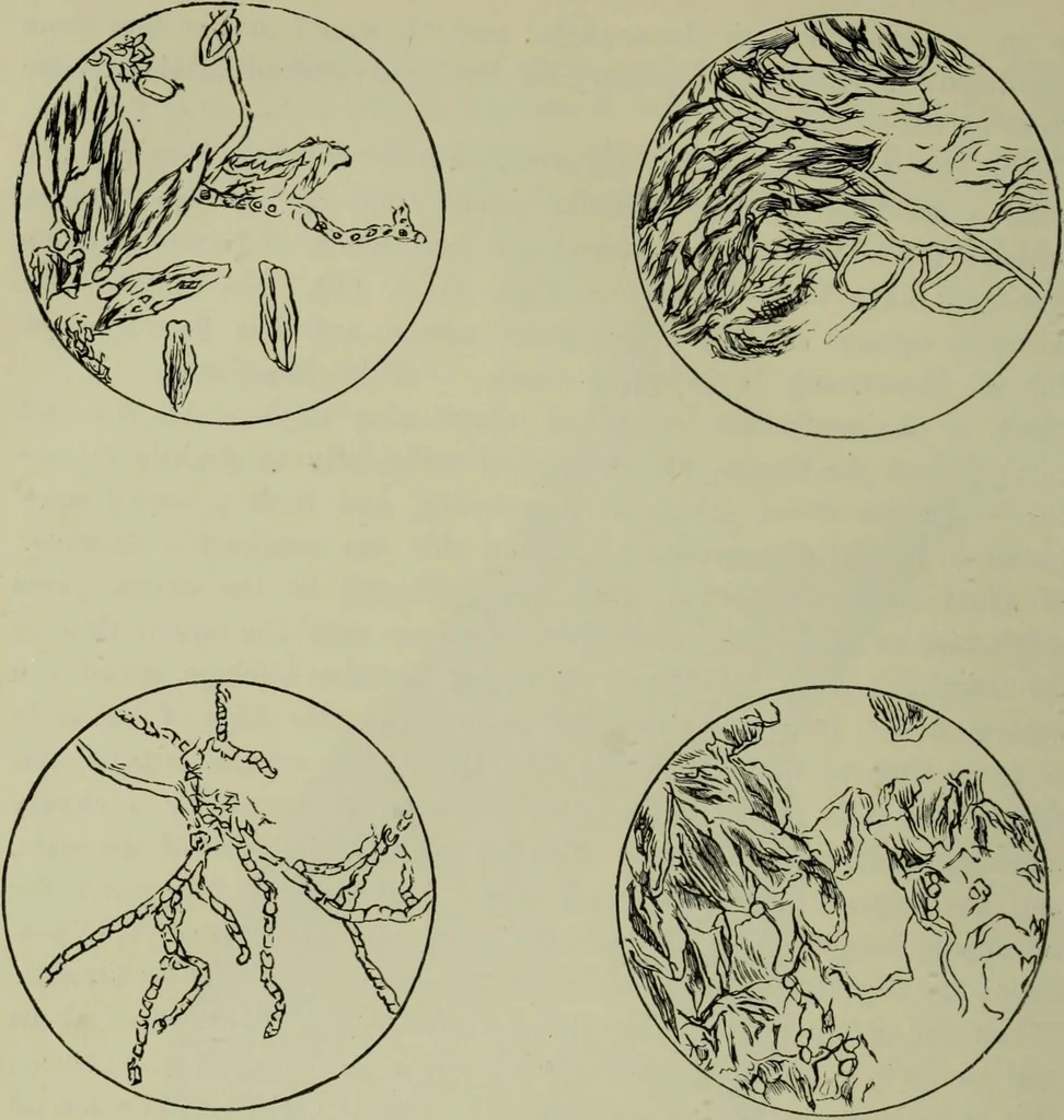 An illustration from A treatise on diseases of the skin with special reference to their diagnosis and treatment : including an analysis of 12,000 consecutive cases / Thomas McCall Anderson., 1894, leaf 636