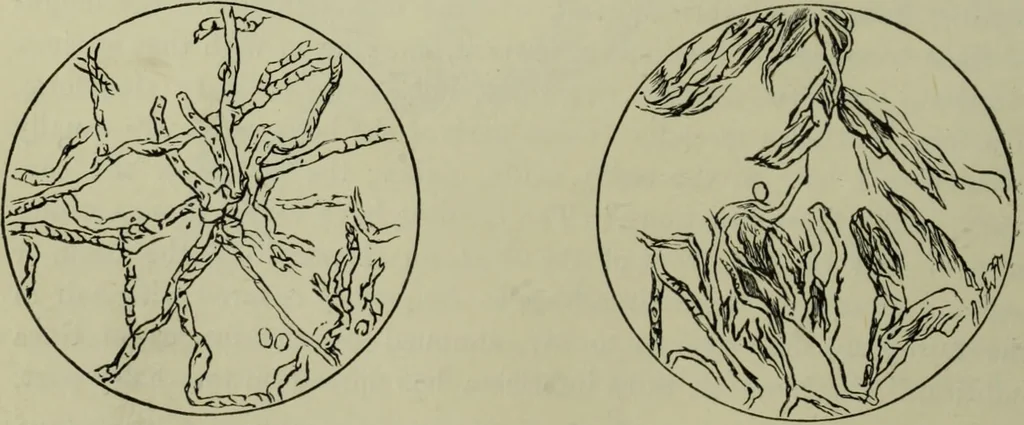 An illustration from A treatise on diseases of the skin with special reference to their diagnosis and treatment : including an analysis of 12,000 consecutive cases / Thomas McCall Anderson., 1894, leaf 636
