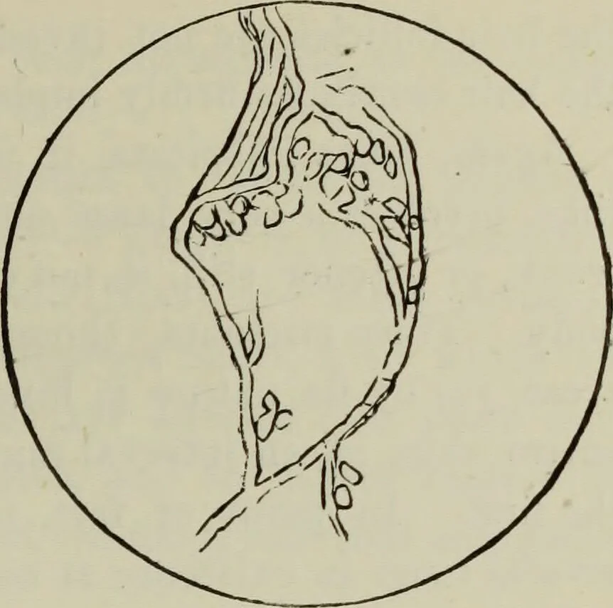 An illustration from A treatise on diseases of the skin with special reference to their diagnosis and treatment : including an analysis of 12,000 consecutive cases / Thomas McCall Anderson., 1894, leaf 637
