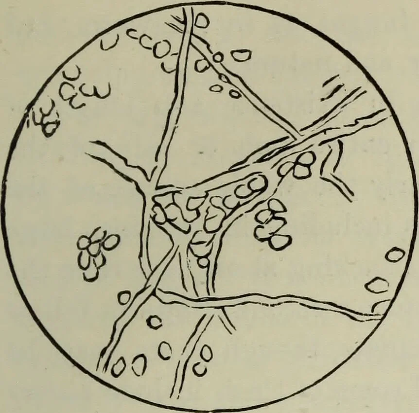 An illustration from A treatise on diseases of the skin with special reference to their diagnosis and treatment : including an analysis of 12,000 consecutive cases / Thomas McCall Anderson., 1894, leaf 637