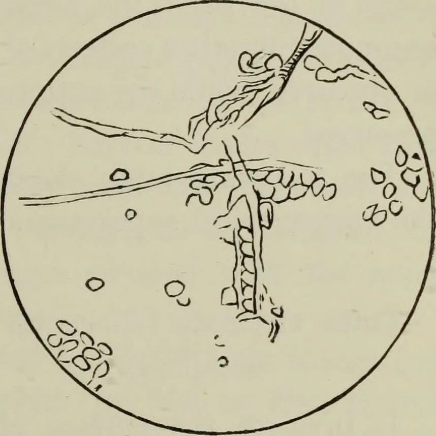 An illustration from A treatise on diseases of the skin with special reference to their diagnosis and treatment : including an analysis of 12,000 consecutive cases / Thomas McCall Anderson., 1894, leaf 637
