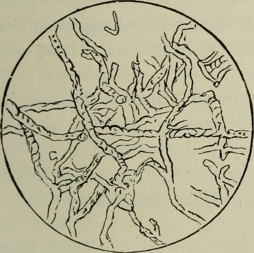 An illustration from A treatise on diseases of the skin with special reference to their diagnosis and treatment : including an analysis of 12,000 consecutive cases / Thomas McCall Anderson., 1894, leaf 637