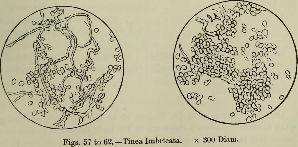 An illustration from A treatise on diseases of the skin with special reference to their diagnosis and treatment : including an analysis of 12,000 consecutive cases / Thomas McCall Anderson., 1894, leaf 637