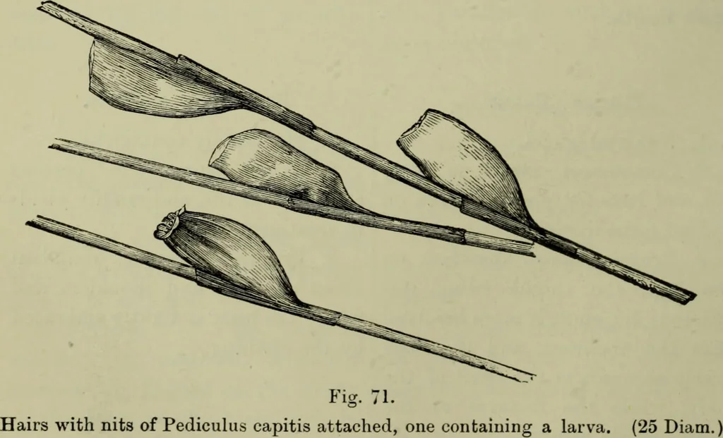 An illustration from A treatise on diseases of the skin with special reference to their diagnosis and treatment : including an analysis of 12,000 consecutive cases / Thomas McCall Anderson., 1894, leaf 666