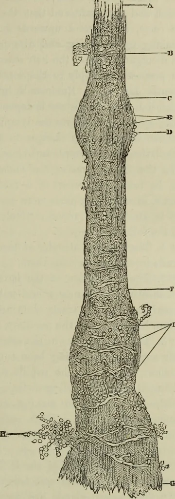 An illustration from A treatise on diseases of the skin with special reference to their diagnosis and treatment : including an analysis of 12,000 consecutive cases / Thomas McCall Anderson., 1894, leaf 81
