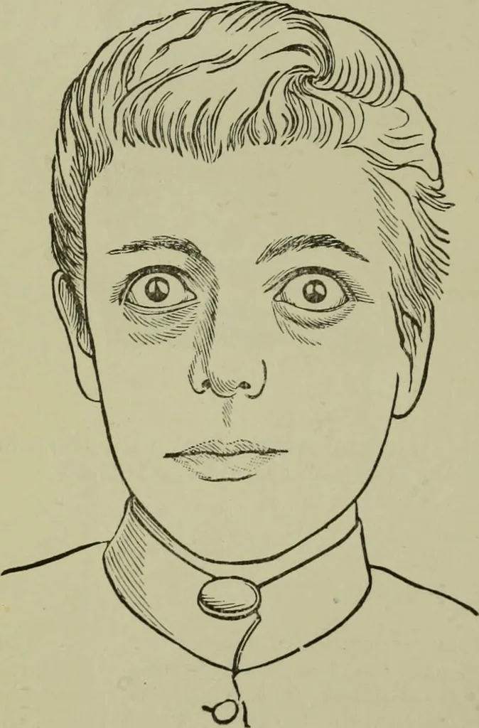 An illustration from A treatise on diseases of the skin with special reference to their diagnosis and treatment : including an analysis of 12,000 consecutive cases / Thomas McCall Anderson., 1894, leaf 814