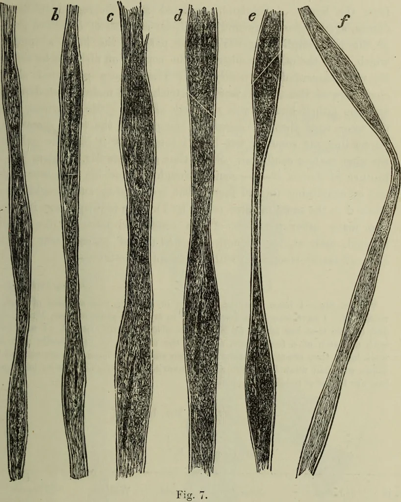 An illustration from A treatise on diseases of the skin with special reference to their diagnosis and treatment : including an analysis of 12,000 consecutive cases / Thomas McCall Anderson., 1894, leaf 89