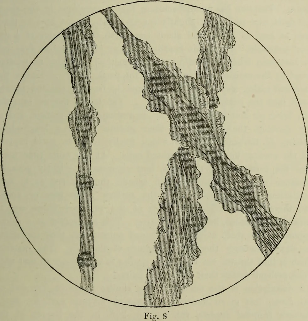 An illustration from A treatise on diseases of the skin with special reference to their diagnosis and treatment : including an analysis of 12,000 consecutive cases / Thomas McCall Anderson., 1894, leaf 91