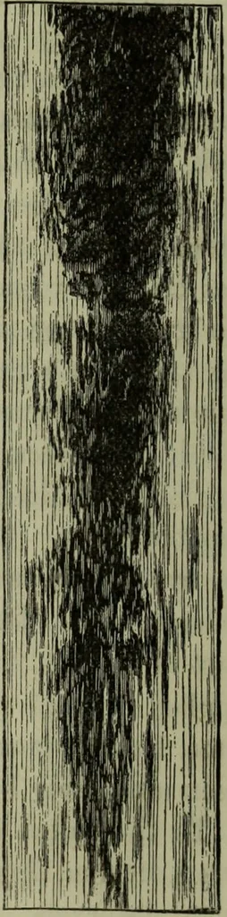 An illustration from A treatise on diseases of the skin with special reference to their diagnosis and treatment : including an analysis of 12,000 consecutive cases / Thomas McCall Anderson., 1894, leaf 96