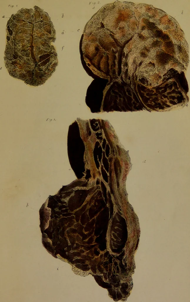 An illustration from Asthma, its varieties and complications, or, Researches into the pathology of disordered respiration; with remarks on the treatment applicable to each variety: illustrated by cases, and plates coloured from nature. Also, a succinct treatise on the principal diseases of the heart / by Francis Hopkins Ramadge., 1847, leaf 513