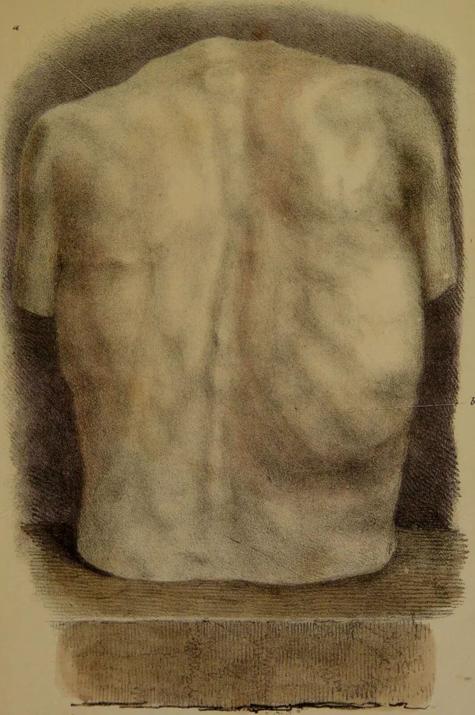 An illustration from Asthma, its varieties and complications, or, Researches into the pathology of disordered respiration; with remarks on the treatment applicable to each variety: illustrated by cases, and plates coloured from nature. Also, a succinct treatise on the principal diseases of the heart / by Francis Hopkins Ramadge., 1847, leaf 523