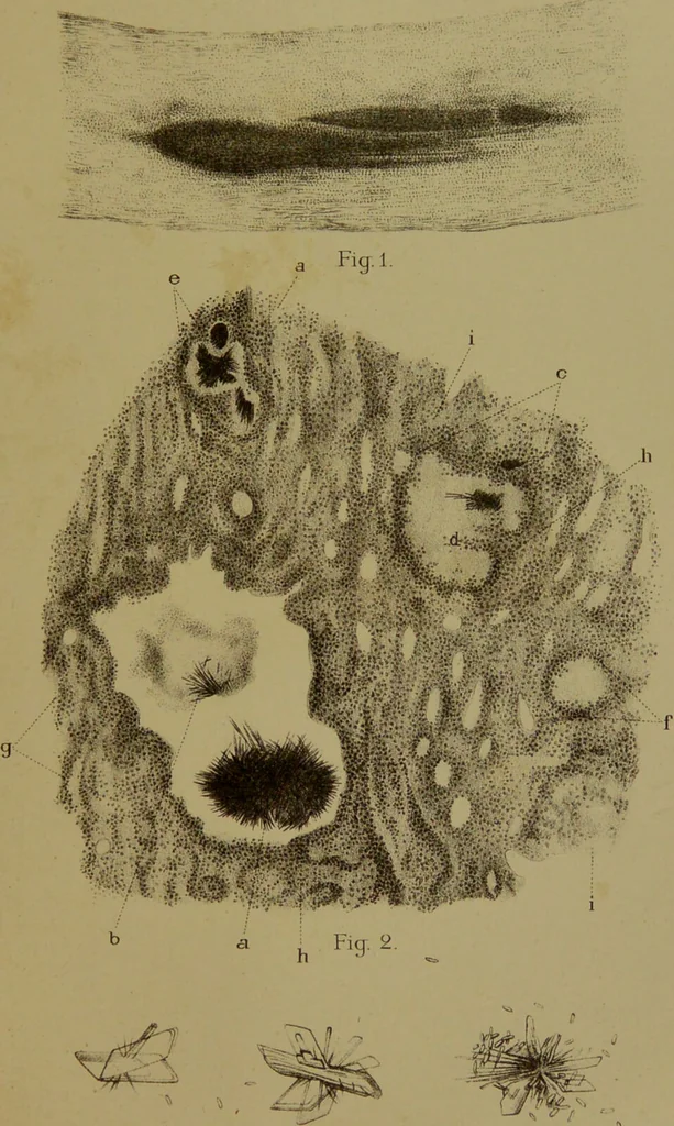 An illustration from La goutte : sa nature et son traitement / Dr W. Ebstein ... ; traduction de Dr E. Chambard ... ; introduction du Professeur Charcot ... ouvrage orné de 12 chromolithographies., 1887, leaf 219