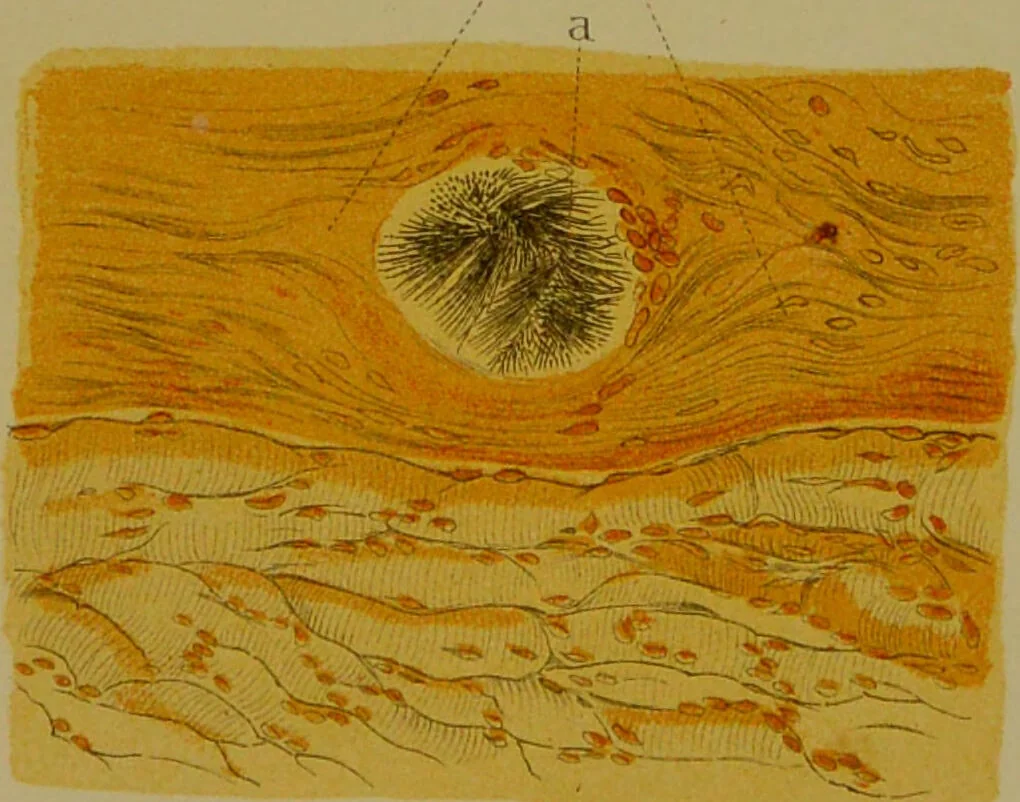 An illustration from La goutte : sa nature et son traitement / Dr W. Ebstein ... ; traduction de Dr E. Chambard ... ; introduction du Professeur Charcot ... ouvrage orné de 12 chromolithographies., 1887, leaf 243