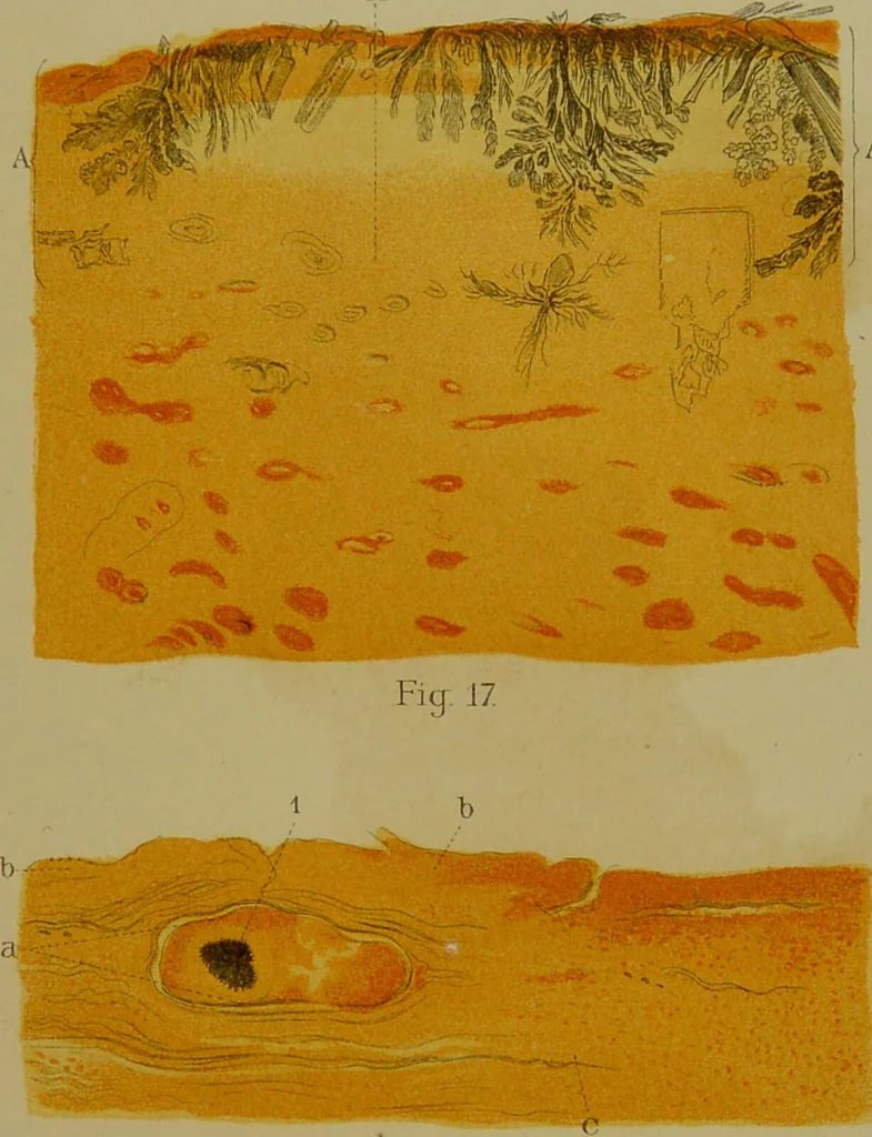 An illustration from La goutte : sa nature et son traitement / Dr W. Ebstein ... ; traduction de Dr E. Chambard ... ; introduction du Professeur Charcot ... ouvrage orné de 12 chromolithographies., 1887, leaf 243