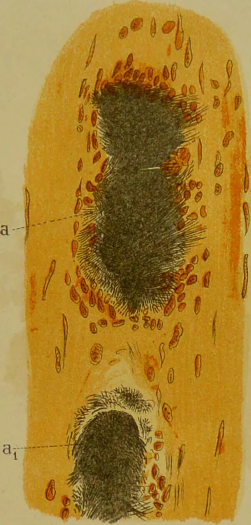 An illustration from La goutte : sa nature et son traitement / Dr W. Ebstein ... ; traduction de Dr E. Chambard ... ; introduction du Professeur Charcot ... ouvrage orné de 12 chromolithographies., 1887, leaf 251