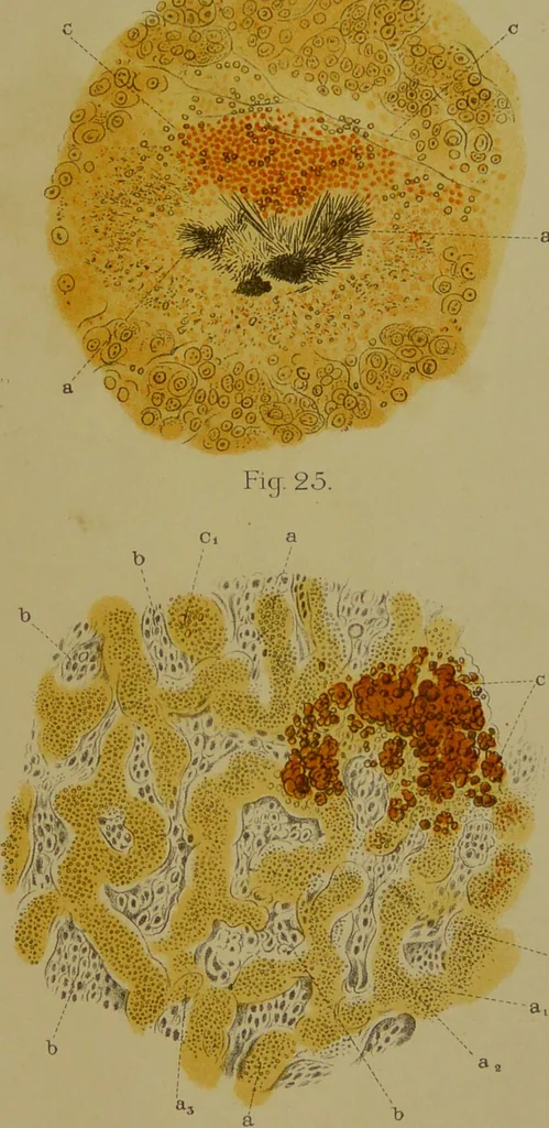 An illustration from La goutte : sa nature et son traitement / Dr W. Ebstein ... ; traduction de Dr E. Chambard ... ; introduction du Professeur Charcot ... ouvrage orné de 12 chromolithographies., 1887, leaf 259