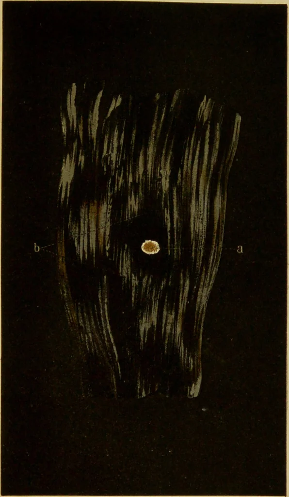 An illustration from La goutte : sa nature et son traitement / Dr W. Ebstein ... ; traduction de Dr E. Chambard ... ; introduction du Professeur Charcot ... ouvrage orné de 12 chromolithographies., 1887, leaf 263