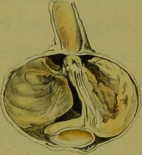 An illustration from A treatise on some practical points relating to the diseases of the eye / by the late John Cunningham Saunders; to which is added, a short account of the author's life, and his method of curing the congenital cataract, by his friend and colleague, J. R. Farre. The whole illustrated by colour engravings., 1811, leaf 253