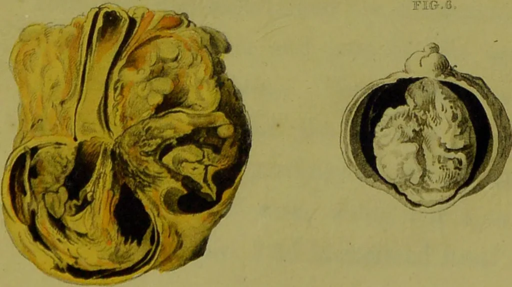 An illustration from A treatise on some practical points relating to the diseases of the eye / by the late John Cunningham Saunders; to which is added, a short account of the author's life, and his method of curing the congenital cataract, by his friend and colleague, J. R. Farre. The whole illustrated by colour engravings., 1811, leaf 253