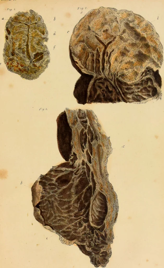 An illustration from Asthma : its varieties and complications, or, Researches into the pathology of disordered respiration; with remarks on the treatment applicable to each variety: illustrated by cases, and plates coloured from nature. Also, a succinct treatise on the principal diseases of the heart ... / by Francis Hopkins Ramadge., 1847, leaf 493