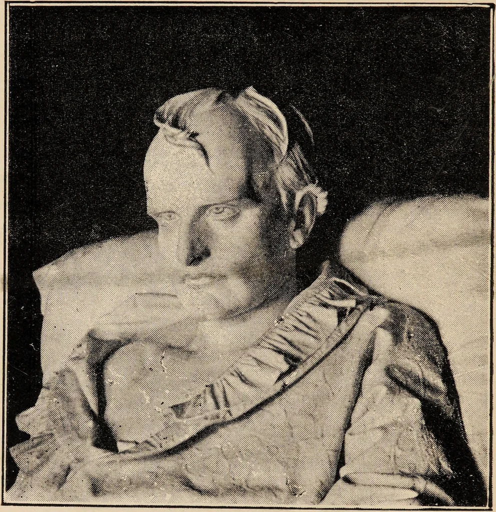 An illustration from Life of Dr. Franc̦ois Joseph Gall : craniologist and founder of phrenology / by Miss Jessie A. Fowler, F.A.I., co-editor of "The phrenological magazine"; "The phrenological dictionary"; and "Phrenology proved"., 1896, leaf 44