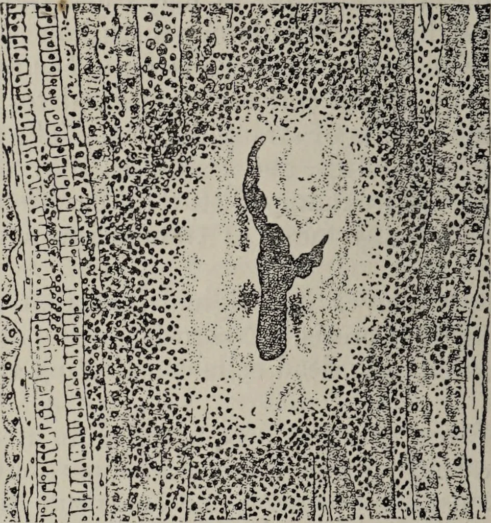 An illustration from A text-book of pathology / by Alfred Stengel ; with 394 illustrations in the text, many of them in colors, and 7 full-page chromolithographic plates., 1903, leaf 102
