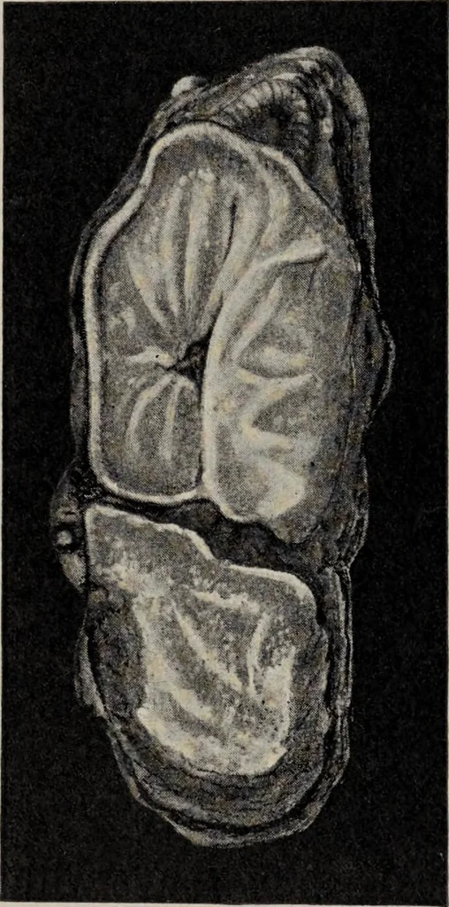 An illustration from A text-book of pathology / by Alfred Stengel ; with 394 illustrations in the text, many of them in colors, and 7 full-page chromolithographic plates., 1903, leaf 104
