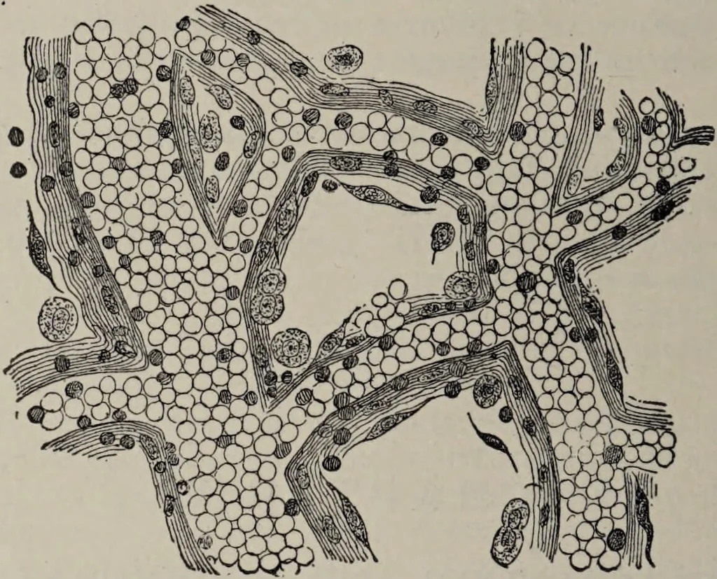 An illustration from A text-book of pathology / by Alfred Stengel ; with 394 illustrations in the text, many of them in colors, and 7 full-page chromolithographic plates., 1903, leaf 110