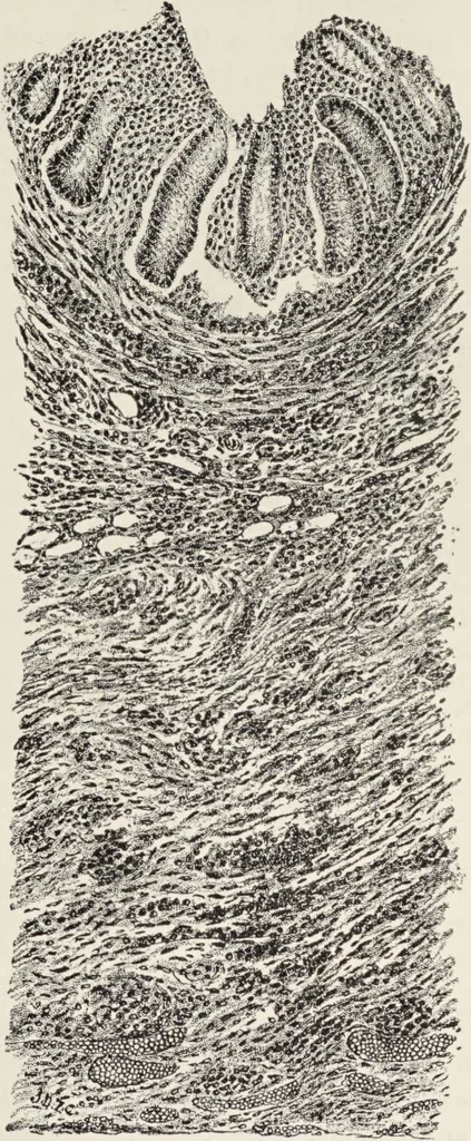 An illustration from A text-book of pathology / by Alfred Stengel ; with 394 illustrations in the text, many of them in colors, and 7 full-page chromolithographic plates., 1903, leaf 113