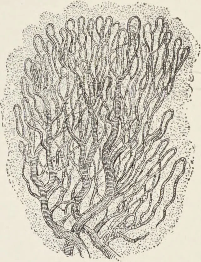 An illustration from A text-book of pathology / by Alfred Stengel ; with 394 illustrations in the text, many of them in colors, and 7 full-page chromolithographic plates., 1903, leaf 123