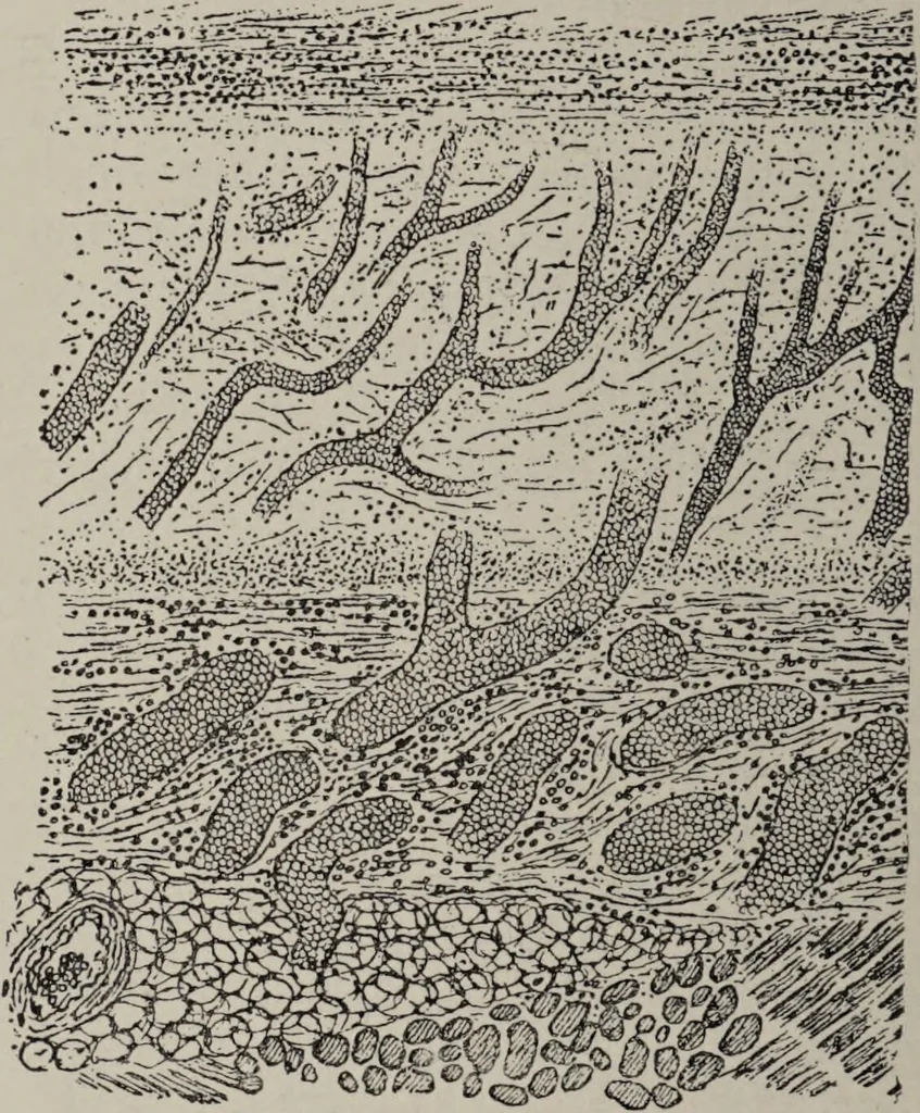 An illustration from A text-book of pathology / by Alfred Stengel ; with 394 illustrations in the text, many of them in colors, and 7 full-page chromolithographic plates., 1903, leaf 124