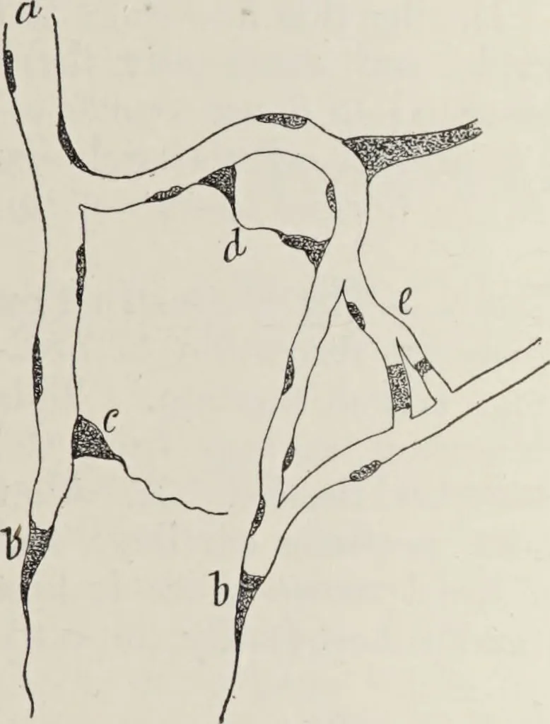 An illustration from A text-book of pathology / by Alfred Stengel ; with 394 illustrations in the text, many of them in colors, and 7 full-page chromolithographic plates., 1903, leaf 129