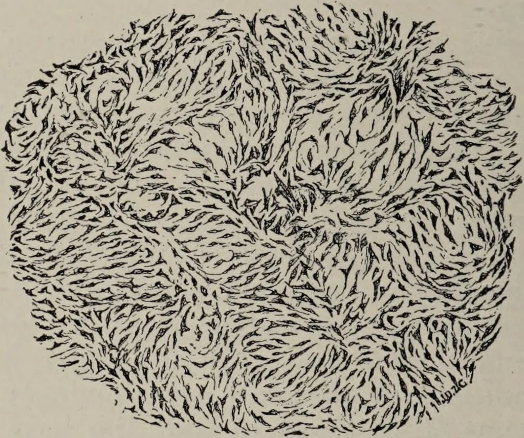An illustration from A text-book of pathology / by Alfred Stengel ; with 394 illustrations in the text, many of them in colors, and 7 full-page chromolithographic plates., 1903, leaf 140