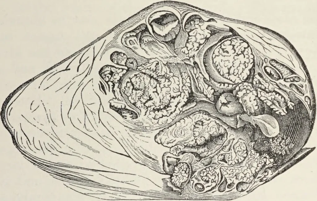 An illustration from A text-book of pathology / by Alfred Stengel ; with 394 illustrations in the text, many of them in colors, and 7 full-page chromolithographic plates., 1903, leaf 141