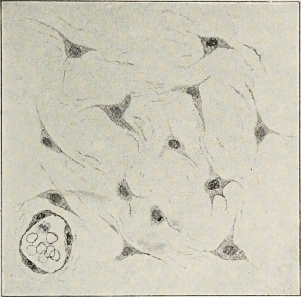 An illustration from A text-book of pathology / by Alfred Stengel ; with 394 illustrations in the text, many of them in colors, and 7 full-page chromolithographic plates., 1903, leaf 143