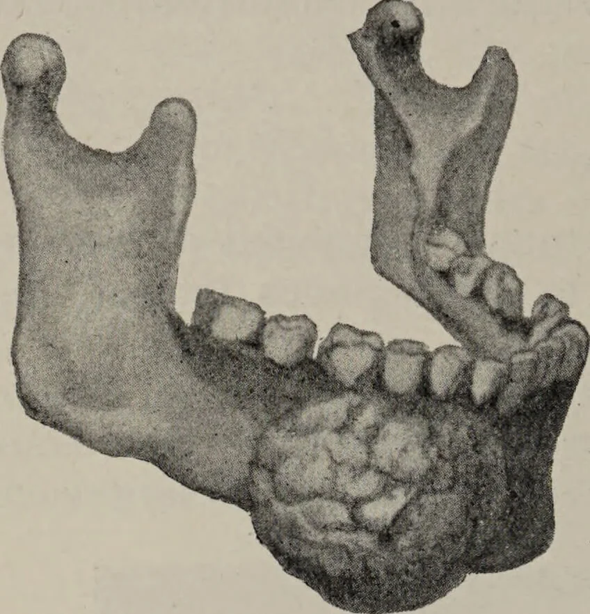 An illustration from A text-book of pathology / by Alfred Stengel ; with 394 illustrations in the text, many of them in colors, and 7 full-page chromolithographic plates., 1903, leaf 150