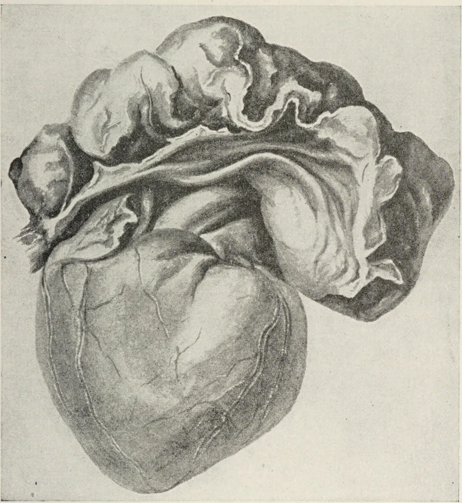 An illustration from A text-book of pathology / by Alfred Stengel ; with 394 illustrations in the text, many of them in colors, and 7 full-page chromolithographic plates., 1903, leaf 155