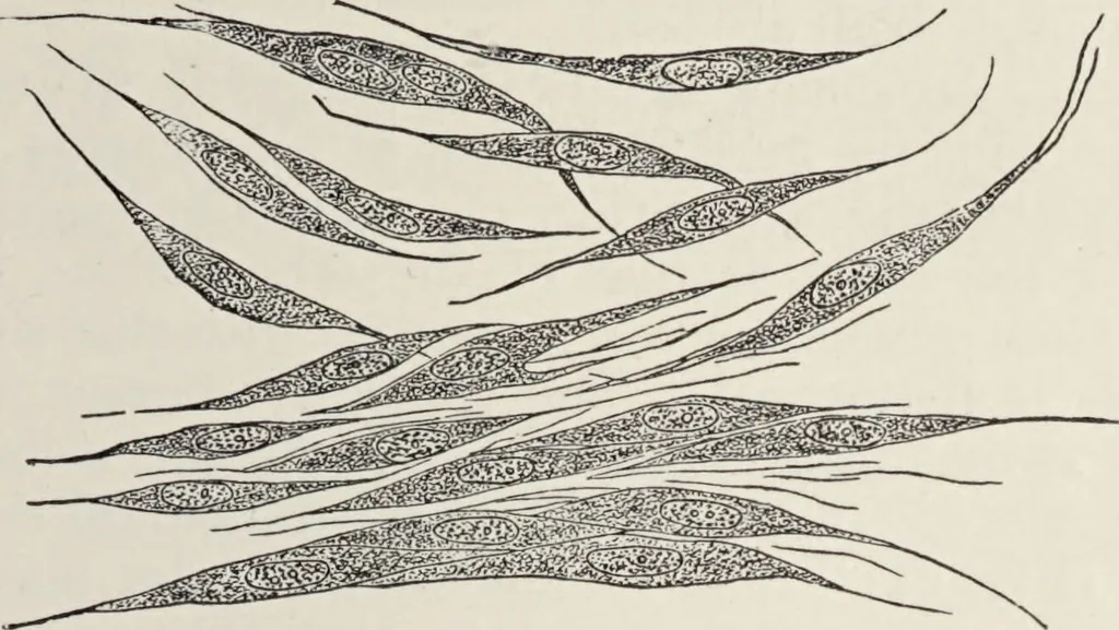 An illustration from A text-book of pathology / by Alfred Stengel ; with 394 illustrations in the text, many of them in colors, and 7 full-page chromolithographic plates., 1903, leaf 161