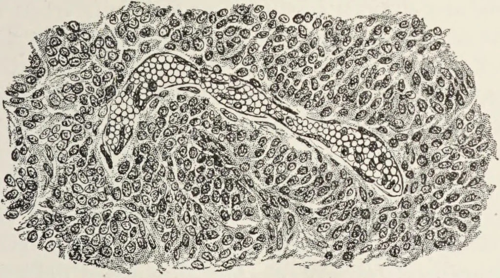 An illustration from A text-book of pathology / by Alfred Stengel ; with 394 illustrations in the text, many of them in colors, and 7 full-page chromolithographic plates., 1903, leaf 161