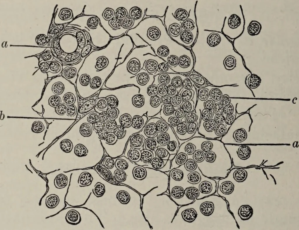 An illustration from A text-book of pathology / by Alfred Stengel ; with 394 illustrations in the text, many of them in colors, and 7 full-page chromolithographic plates., 1903, leaf 162
