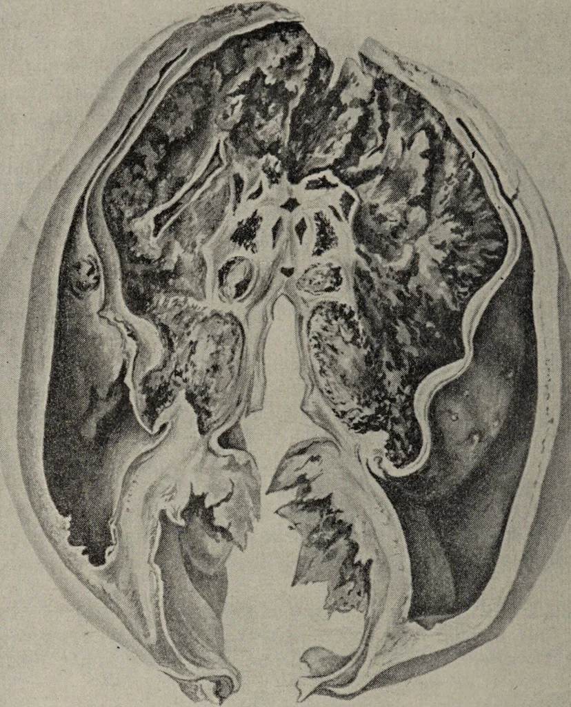 An illustration from A text-book of pathology / by Alfred Stengel ; with 394 illustrations in the text, many of them in colors, and 7 full-page chromolithographic plates., 1903, leaf 170