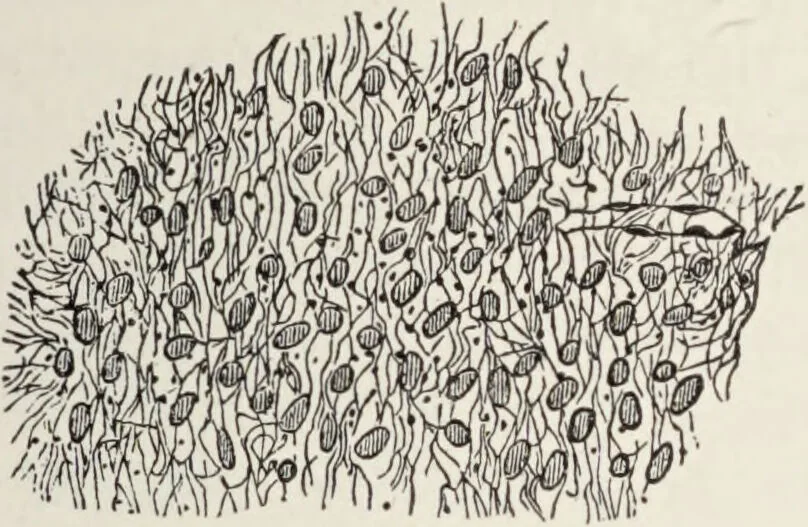 An illustration from A text-book of pathology / by Alfred Stengel ; with 394 illustrations in the text, many of them in colors, and 7 full-page chromolithographic plates., 1903, leaf 171