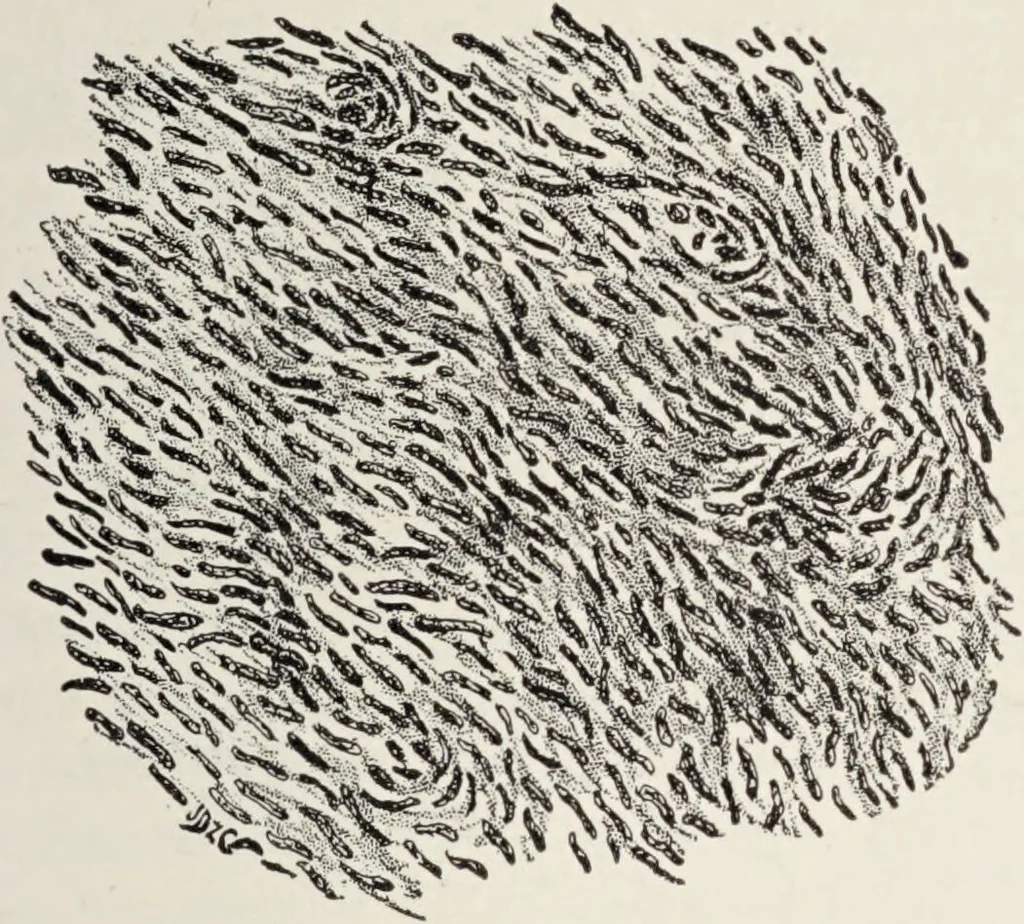 An illustration from A text-book of pathology / by Alfred Stengel ; with 394 illustrations in the text, many of them in colors, and 7 full-page chromolithographic plates., 1903, leaf 175
