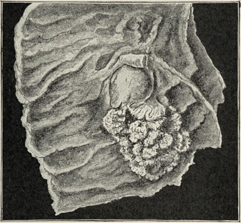 An illustration from A text-book of pathology / by Alfred Stengel ; with 394 illustrations in the text, many of them in colors, and 7 full-page chromolithographic plates., 1903, leaf 185