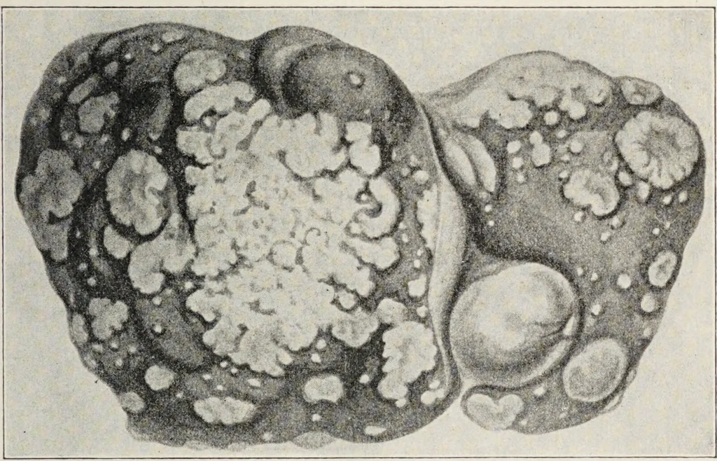 An illustration from A text-book of pathology / by Alfred Stengel ; with 394 illustrations in the text, many of them in colors, and 7 full-page chromolithographic plates., 1903, leaf 185