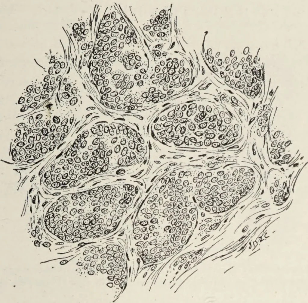 An illustration from A text-book of pathology / by Alfred Stengel ; with 394 illustrations in the text, many of them in colors, and 7 full-page chromolithographic plates., 1903, leaf 193